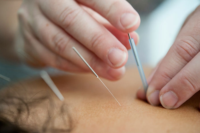 Acupuncture | Dr. Jason Morrison